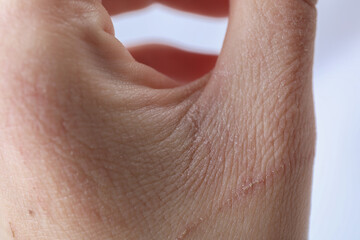 Woman with dry skin on hand against light background, closeup