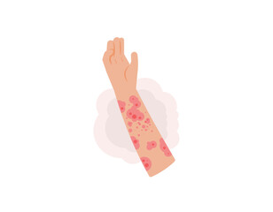lichen planus disease. illustration of a hand with red spots on the skin. itchy skin, red rash, allergies. skin disease. health problems. cartoon or flat illustration design. graphic elements. vector - obrazy, fototapety, plakaty