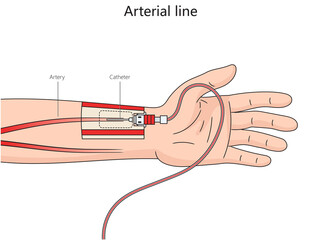 Arterial line structure thin catheter inserted into an artery diagram hand drawn schematic raster illustration. Medical science educational illustration - obrazy, fototapety, plakaty
