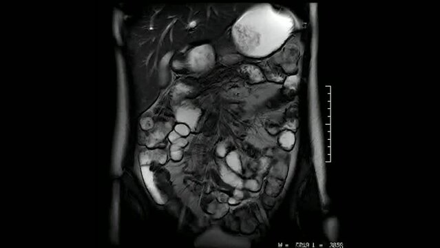 CT scan of abdomen by MRI scan abdominal and front body.