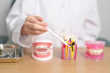 Fototapeta na wymiar Tooth Anatomy and Orthodontic model on dentist table. Oral Teeth and disease. March Oral health, Dentist Day, False Teeth. Toothache and Children Dental Health Month and May Orthodontic Health Day