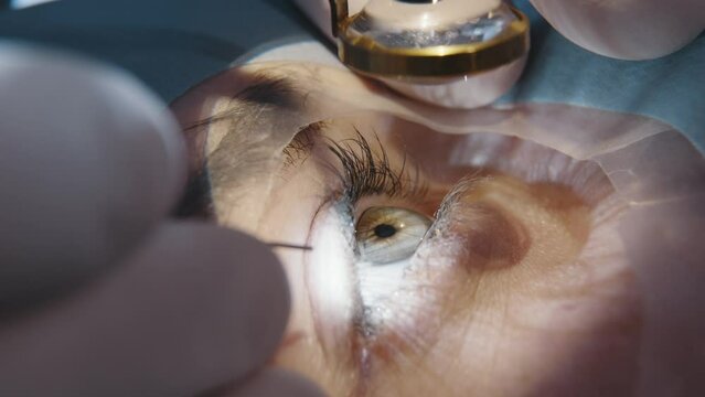 Laser vision correction. Patient and surgeon in operating room during ophthalmic surgery or diagnostics. Open eye. Patient under sterile cover. Close-up