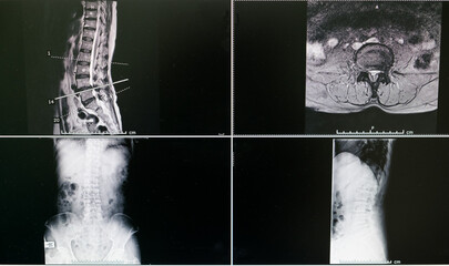 x ray image of a spine