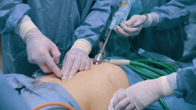 Video endoscopic surgery. The surgeon inserts an endoscope into the patient's abdominal cavity. Removal of the gallbladder in the clinic.