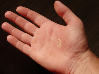 Torn callus of the hand close-up. Rough skin of male hand. Сlose up body with damage human skin