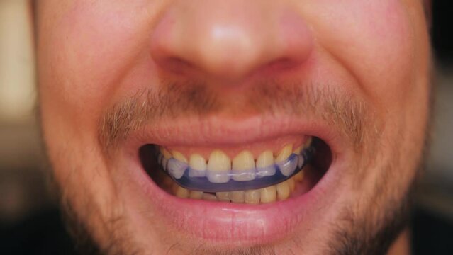 Dental teeth aligner and night guard. Orthodontic braces close up.