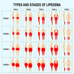 Types and stages of Lipedema medical illustration demonstration
