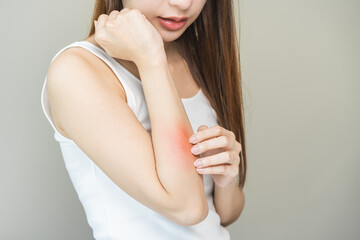 Dermatology asian young woman, girl allergy, allergic reaction from atopic, insect bites on her...