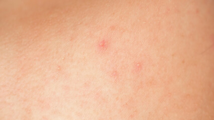 Problem skin with acne. close-up of a body part. - obrazy, fototapety, plakaty