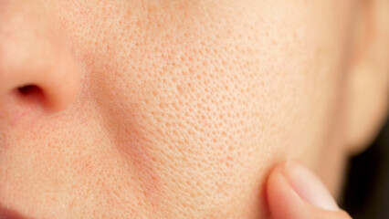 skin texture with enlarged pores. Problem skin. part of a woman face. acne. skin, pore, face, dry,...