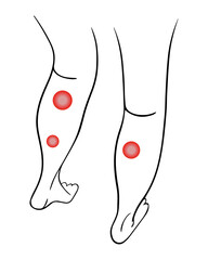 Varicose veins of the legs. Treatment of varicose veins.