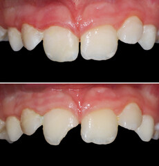 tooth direct restoration