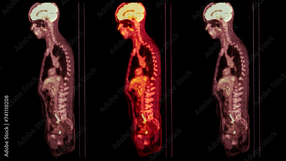 Poster a pet-ct scan image is a diagnostic visualization combining positron emission tomography (pet) and c