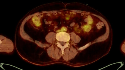 A PET-CT scan image is a diagnostic visualization combining Positron Emission Tomography (PET) and Computed Tomography (CT) for Helps in finding cancer recurrence.