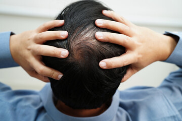Bald head in man, hair loss treatment health problem.