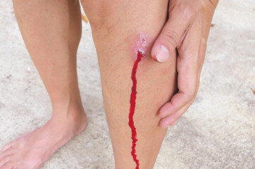 Wound bleed with red blood flow at leg skin