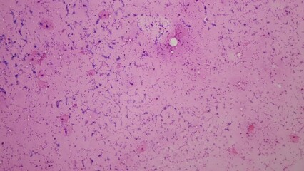 Semen. Qualitative and quantitative visual, physico-chemical and microscopic examination of male semen (ejaculate). 100x magnification. Oligozoospermia. Azoospermia