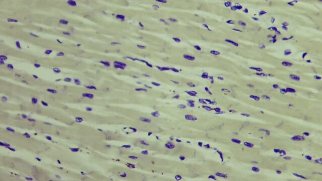 Histologic study of human heart muscle under a microscope. 400x times magnification. Heart failure and natural deterioration
