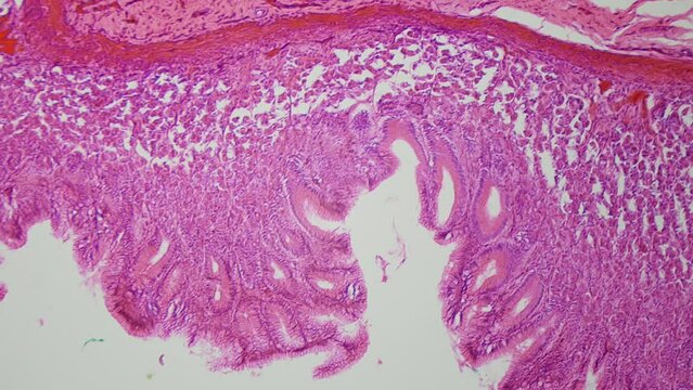 Surface of the human stomach. 100x magnification. Histologic and cytologic examination of patient biopsy. Peptic ulcer and gastritis