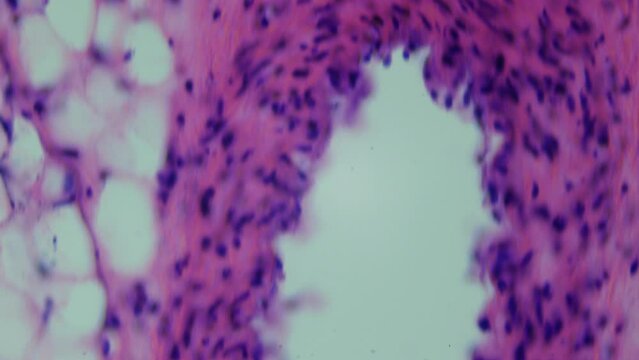 Cross sectional study of the blood vessels. The human circulatory system. Magnification of 1000X times. The pathologist determines the cause of death of a person. Vascular thrombosis