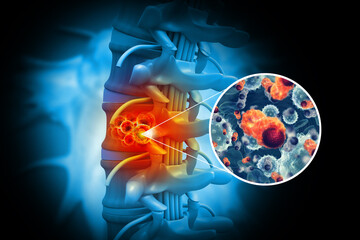 Spine cancer or spinal tumor disease.3d illustration - obrazy, fototapety, plakaty