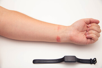 Redness and allergies on a person s wrist from wearing a fitness bracelet with a silicone strap....