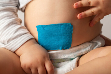The navel is sealed with a blue plaster on the stomach of a child. Treatment of umbilical hernia in...