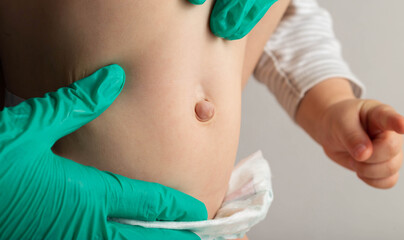 A doctor surgeon in medical gloves examines the abdomen of a newborn baby with an enlarged umbilical ring and an umbilical hernia, close-up, medical