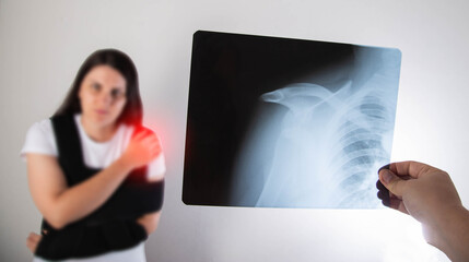 The doctor holds in his hand a medical x-ray of a dislocated humerus and a fractured collarbone against the background of a girl patient whose shoulder hurts. Fixing bandage for the shoulder joint.  - obrazy, fototapety, plakaty