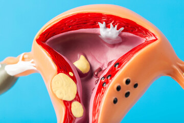 Medical mockup of the female reproductive system on a blue background. Concept of uterine cancer,...