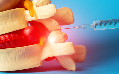 Injection into the intervertebral hernia of a medical model on a blue background, close-up....