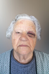 elderly woman with a bruise on her eyelid after suffering a fall at home