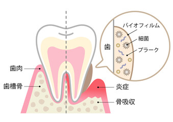 バイオフィルムと健康な歯