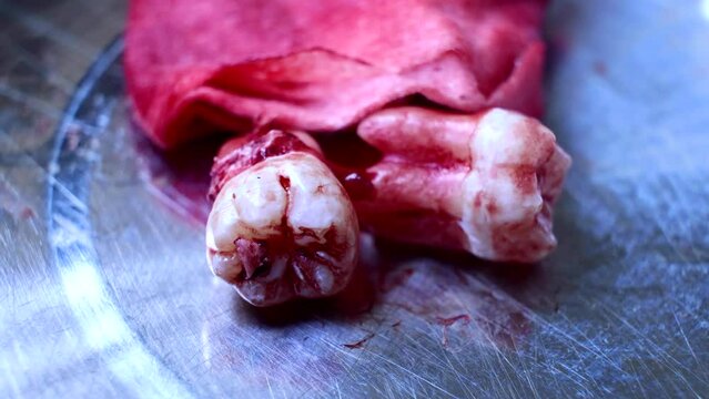 Freshly extracted molar wisdom teeth with blood stained gauze placed on stainless steel container in dental clinic