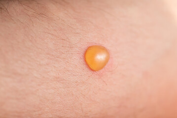 Small orange blister on skin, close up. Macro shot of tumor or burn on the skin of young person