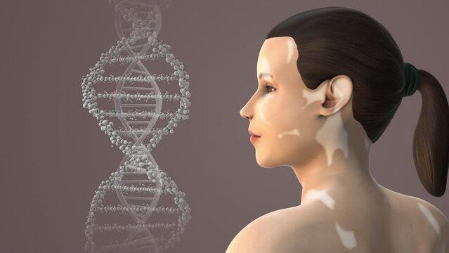Leukoderma or Vitiligo caused by hormonal imbalance
