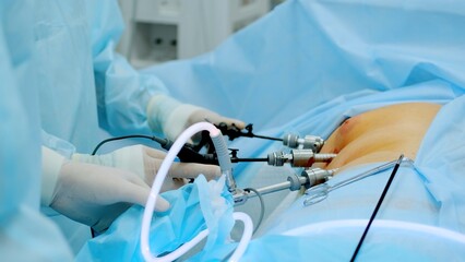 Hands of surgeons with the help of endoscopic equipment and instruments operate. performing laparoscopic surgery using endoscopic and laparoscopic instruments. laparoscopic instrument. 
