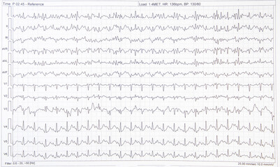 A graphic EKG electrocardiogram of a person with heart disease