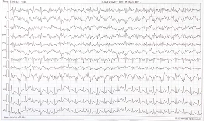 Fotobehang ECG electrocardiogram of a heart disease person © sebi_2569