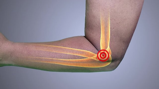 Tennis elbow carpal tunnel syndrome