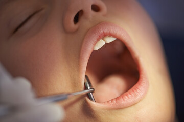 Closeup, child and dentist with mirror in mouth for gum disease and oral hygiene with dental...