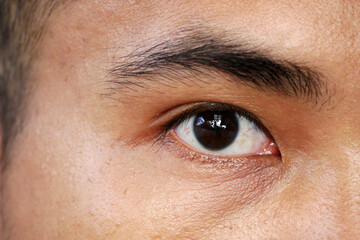 Man's eyes with inflamed and dilated red capillaries. Bleeding under the conjunctiva....