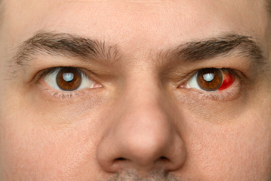 a human eye with a burst vessel and blood leaking into the eyeball, hemorrhage, a close view of a man's face