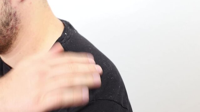 dandruff on a man's shoulders