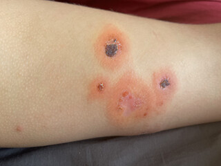 Human shin leg closeup.  Body with skin problem. Infectious disease. Allergy, dermatitis, virus or...