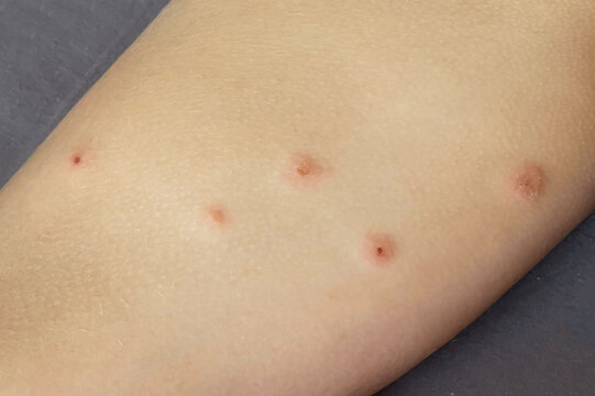 Bedbug bites. Body with skin problem. Infectious disease. Allergy, dermatitis, virus or bacterial infection. Dermatology,  medicine and health care concept.