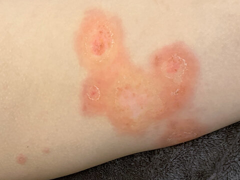 Human thigh closeup. Body with skin problem. Infectious disease. Allergy, dermatitis, virus or bacterial infection. Dermatology, medicine and health care concept.
