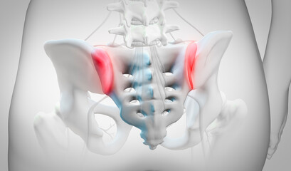 Inflammation of sacroiliac joints, called Sacroiliitis, causing pain in the lower back. 3d illustration on white background