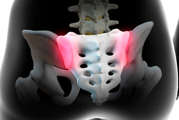 Inflammation of sacroiliac joints, called Sacroiliitis, causing pain in the lower back. 3d illustration - obrazy, fototapety, plakaty