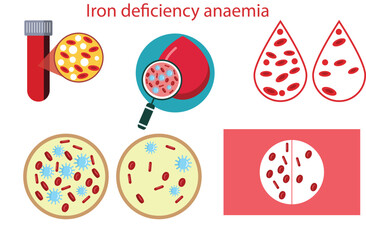 Iron deficiency anaemia,reduction in the number of red blood cells,Iron deficiency anemia.The difference of Anemia amount of red blood cell and normal,Anemia and Hemophilia icon.,five vectors - obrazy, fototapety, plakaty